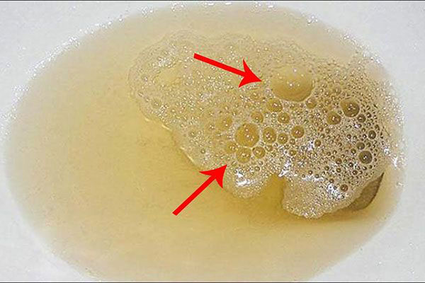 Đi ngoài ra bọt là bệnh lý gì? Có nguy hiểm không?